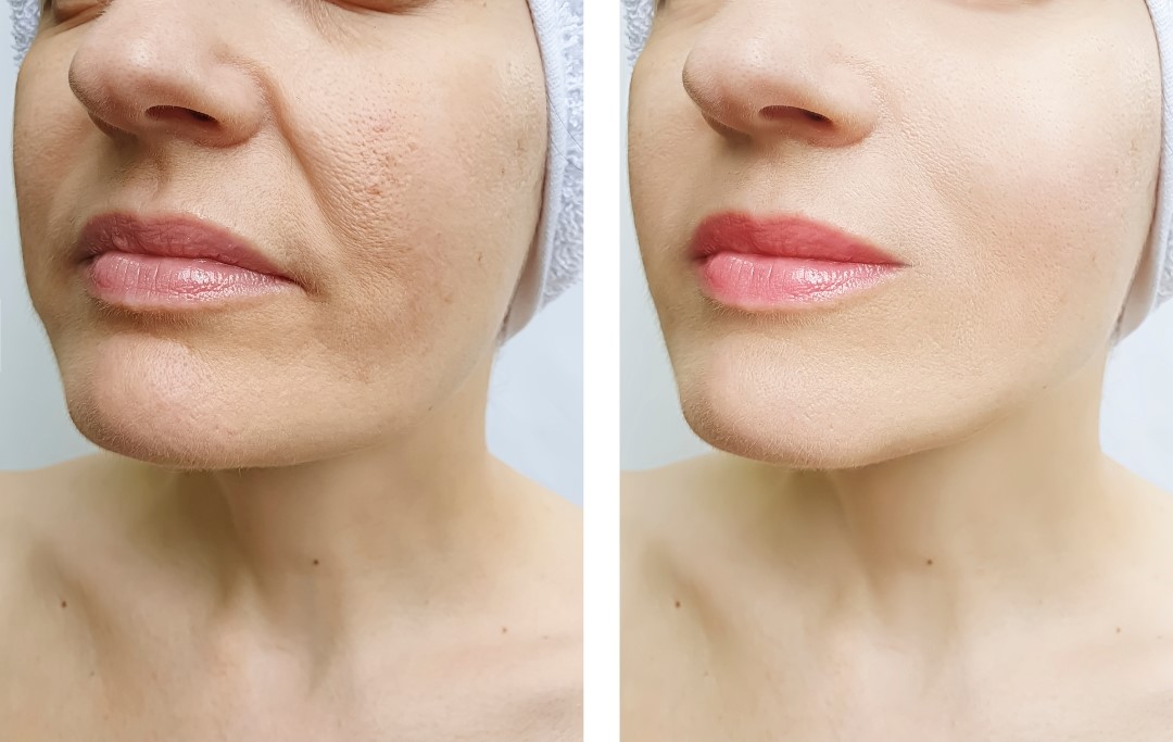 prima e dopo il trattamento soft laser per cicatrici da acne
